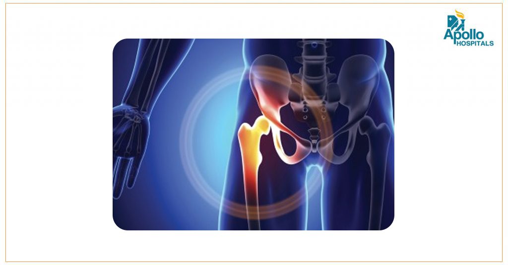 FAQ – Hip Replacement Surgery