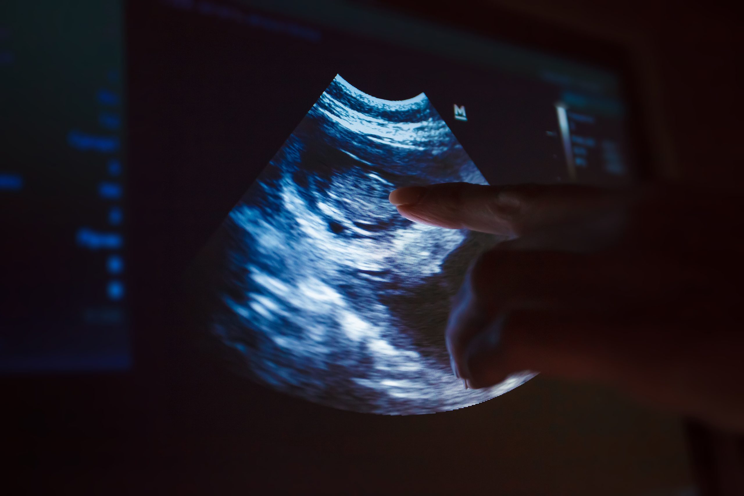 Choroid Plexus Cyst : Causes, Complication and Treatment