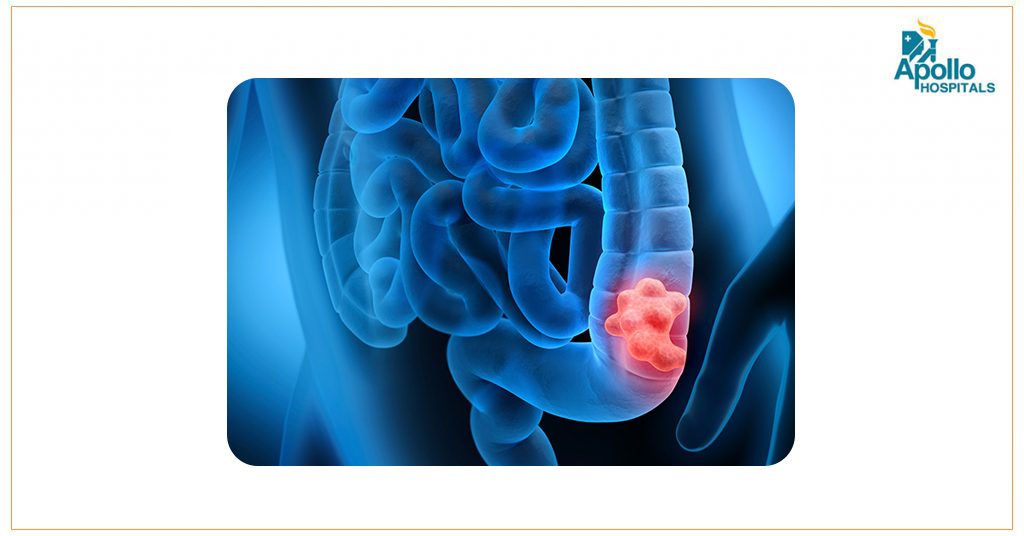 Colorectal cancer – Everything you need you