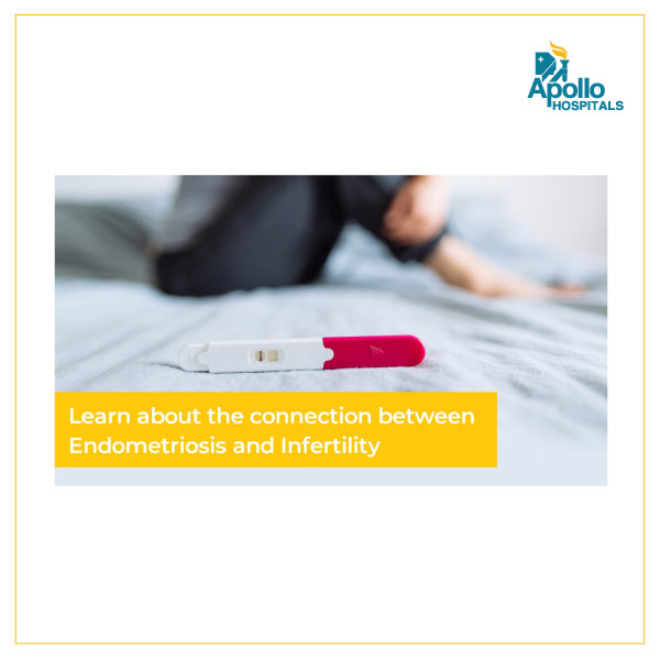 Endometriosis and Infertility