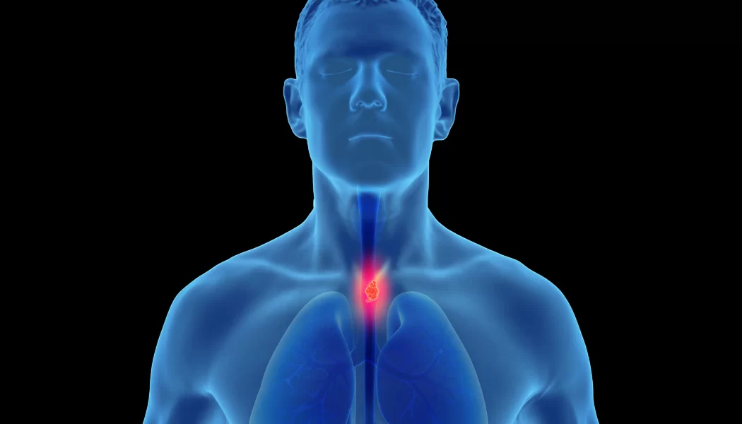 Understanding Esophageal Cancer – A Comprehensive Guide