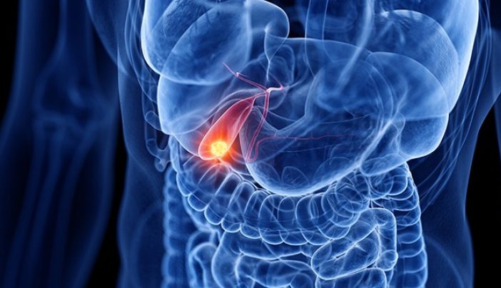 Early Warning Signs of Gallbladder Cancer: Recognizing Symptoms and Seeking  Timely Diagnosis