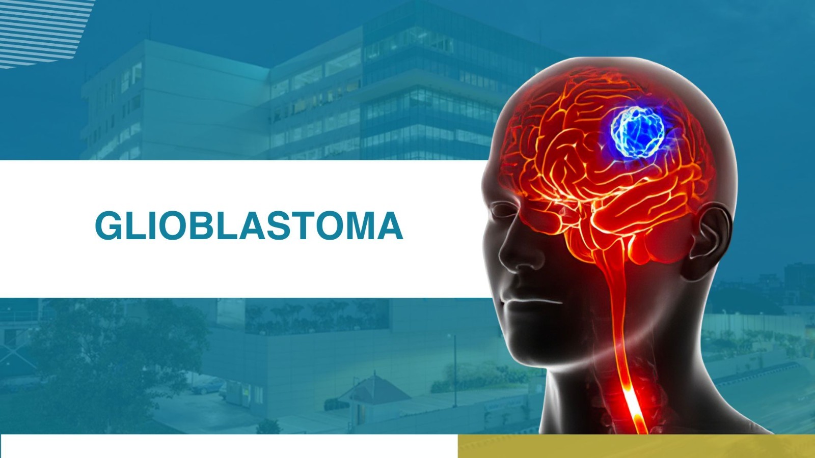 Glioblastoma: Understanding This Aggressive Brain Cancer