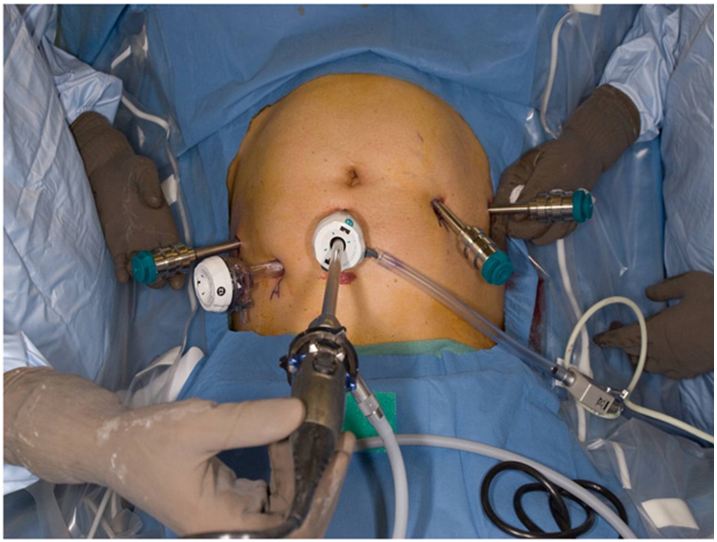 Gynecological surgeries through Robotic technique