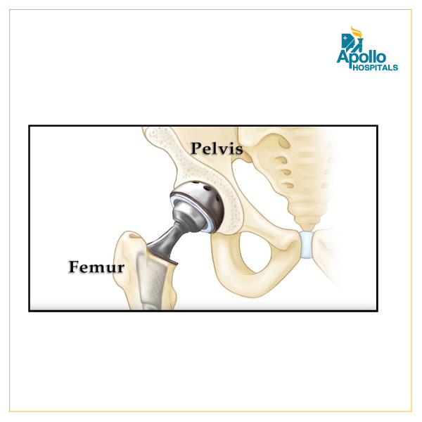 Hip arthroplasty surgery in autoimmune arthritis
