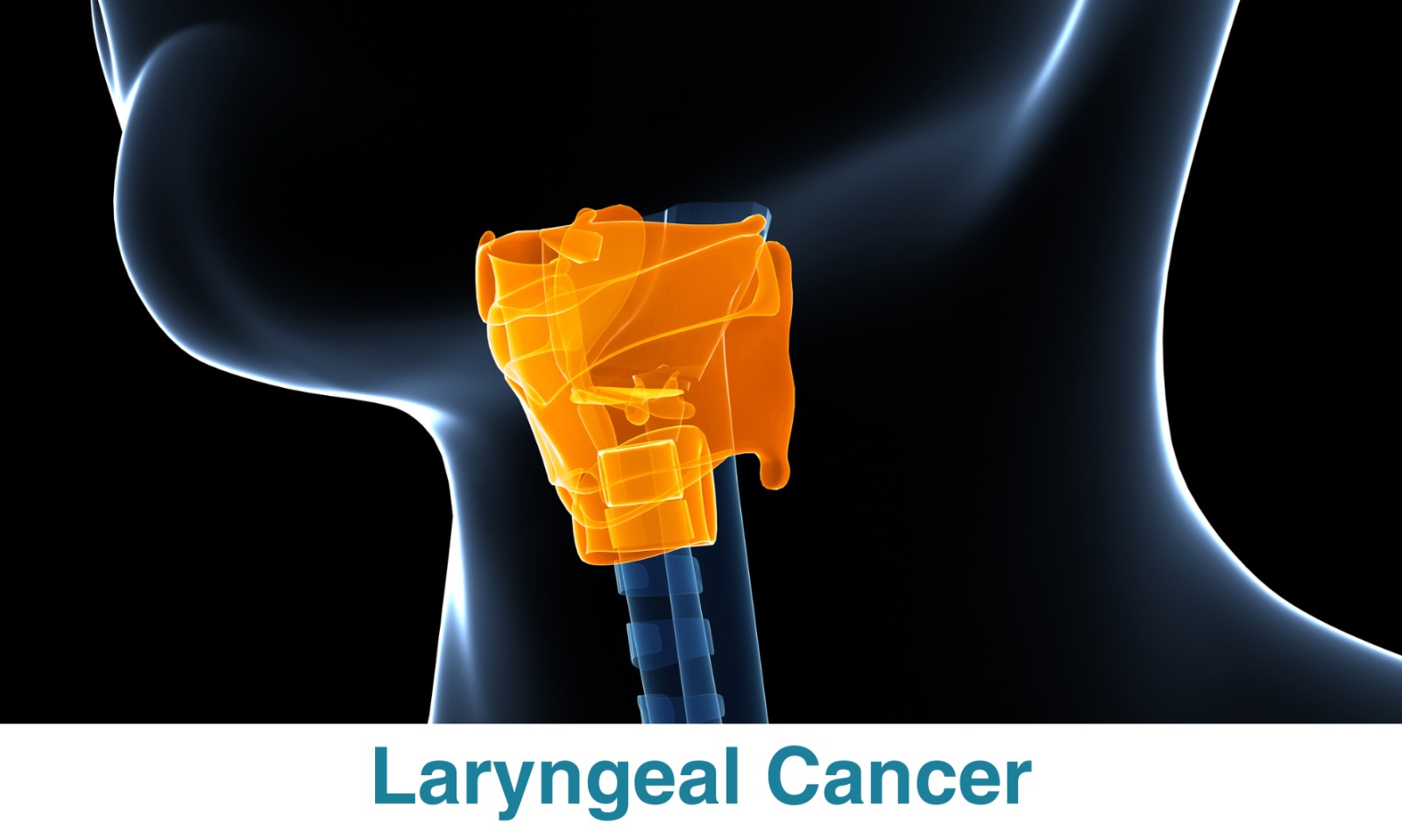 Laryngeal Cancer