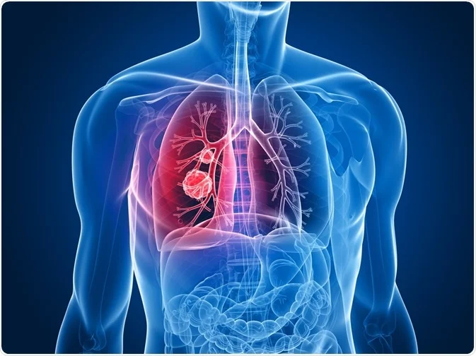 7 Healthy Habits That Help You During Lung Cancer Treatment