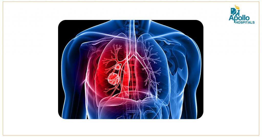 Is There a Cure for Lung Cancer?