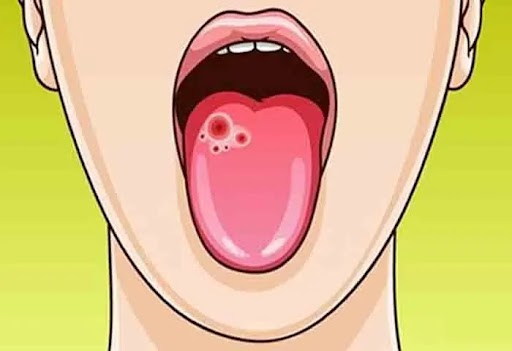 9 Proven Ways to Prevent Oral Cancer