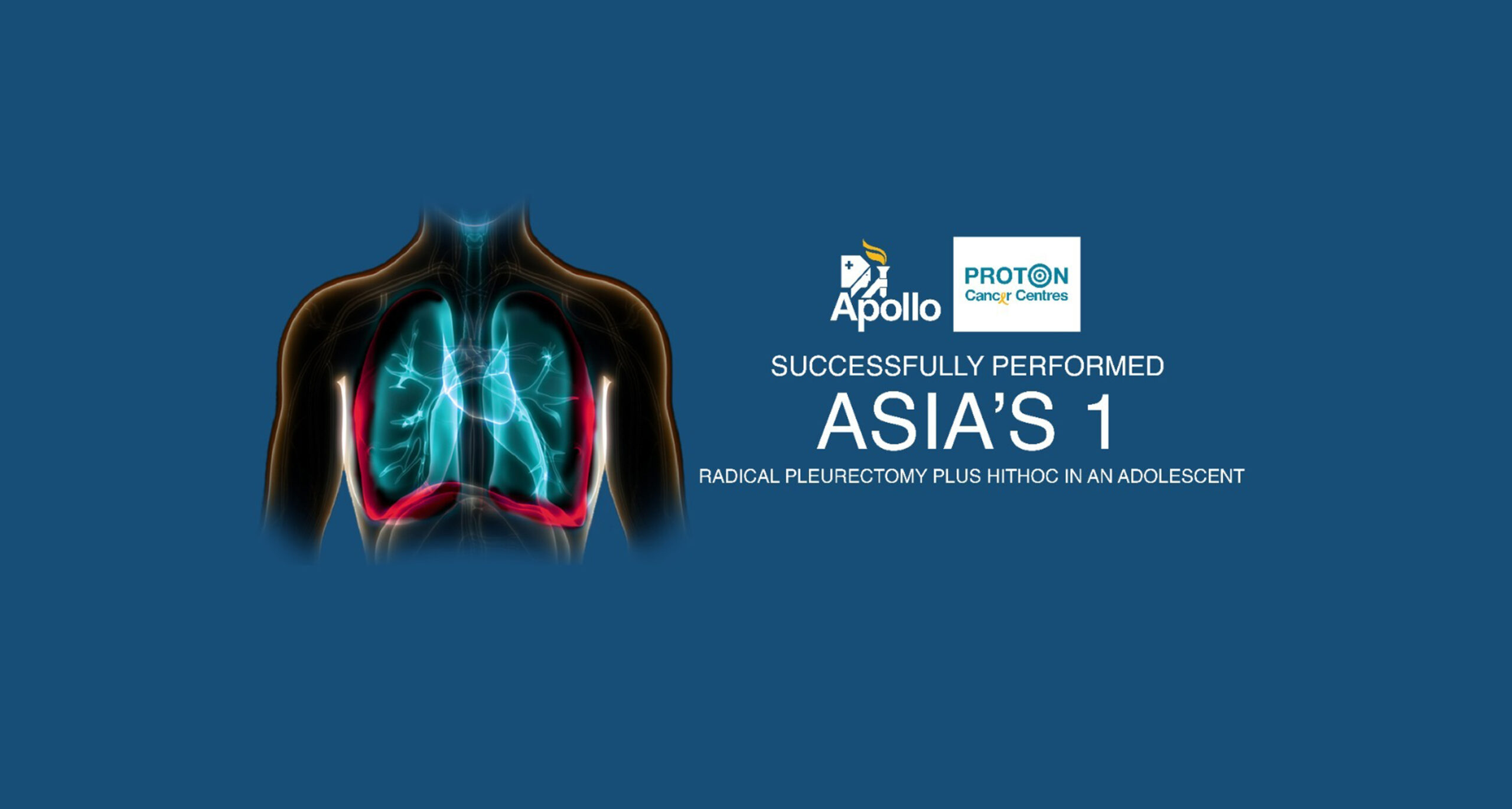 Radical Pleurectomy: What You Need to Know