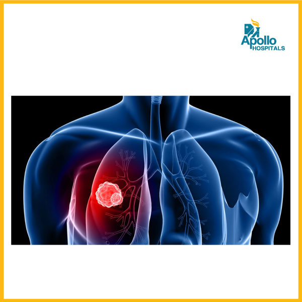 The Silent Threat: Understanding Radon-Induced Lung Cancer