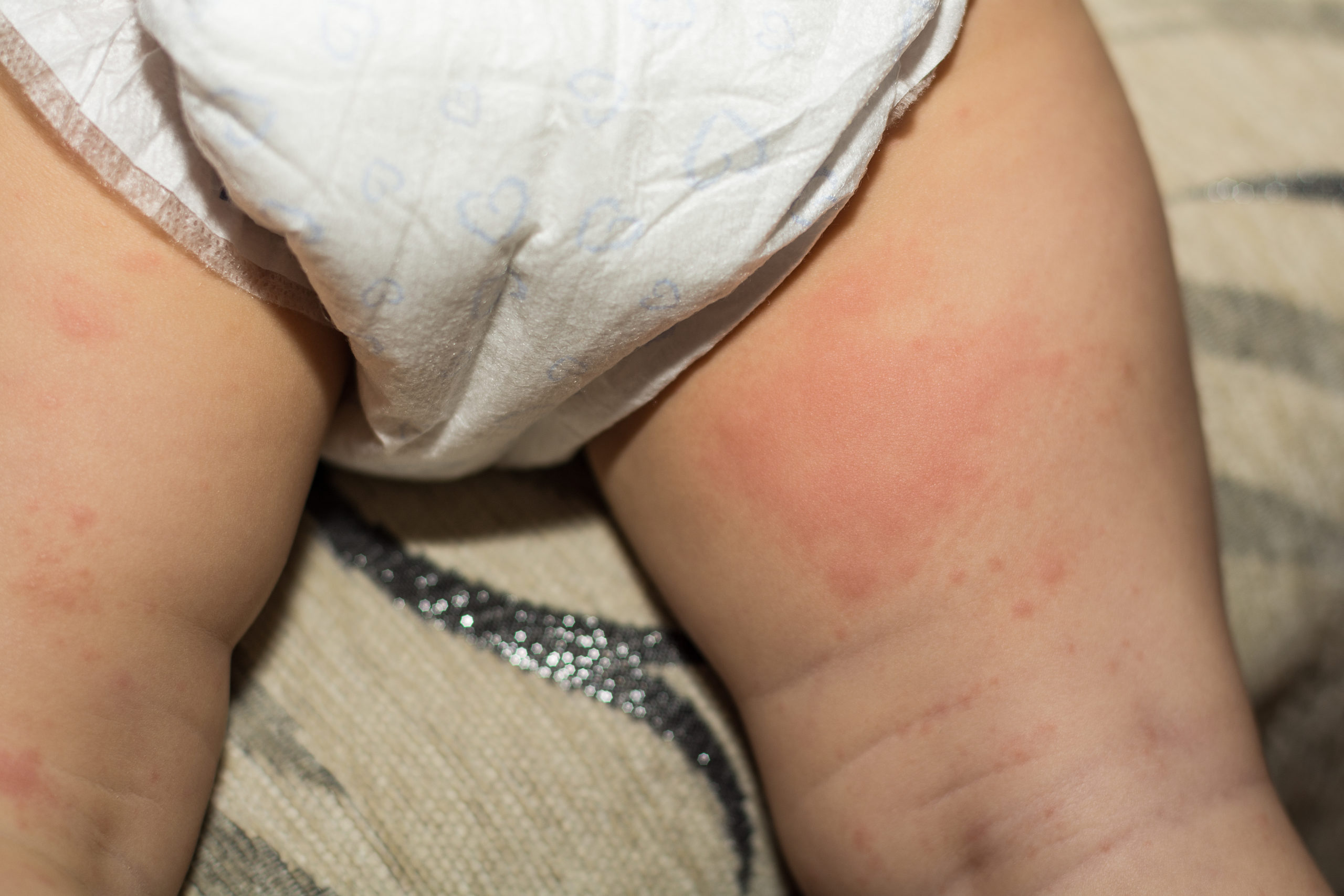 Diaper Rash: Symptoms, Causes, Treatment and Prevention