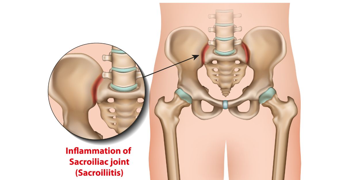 Sacroiliitis : Symptoms, Causes, Treatment, Home Remedies &amp; Exercises