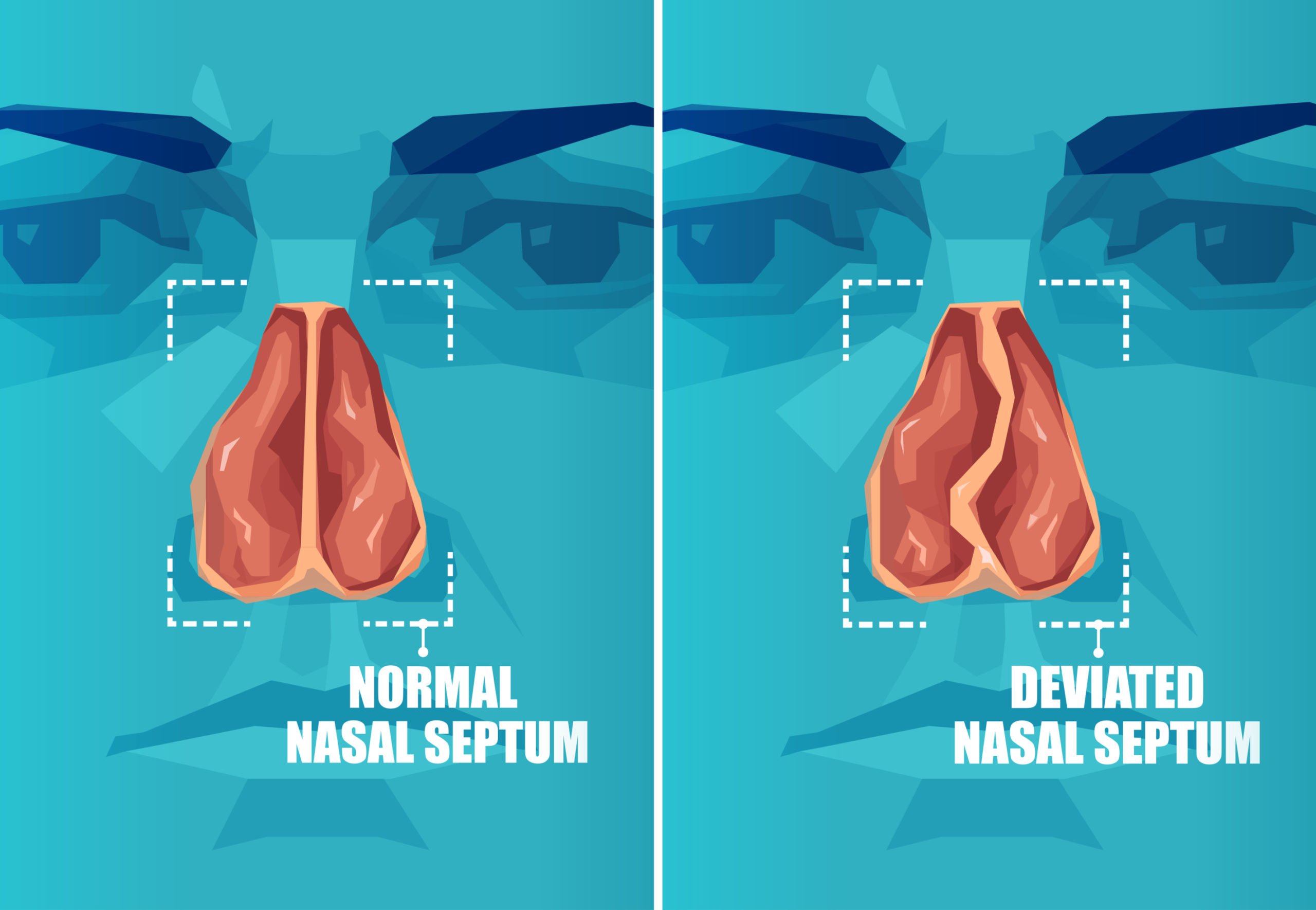 Nasal Septum Deviation – Symptoms, Causes &amp; Treatment