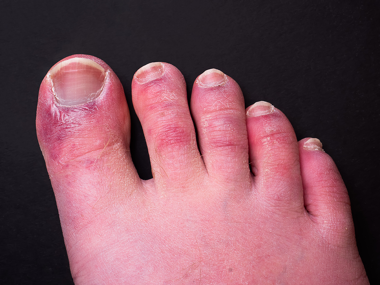 Chilblains: Causes, Symptoms &amp; Treatment