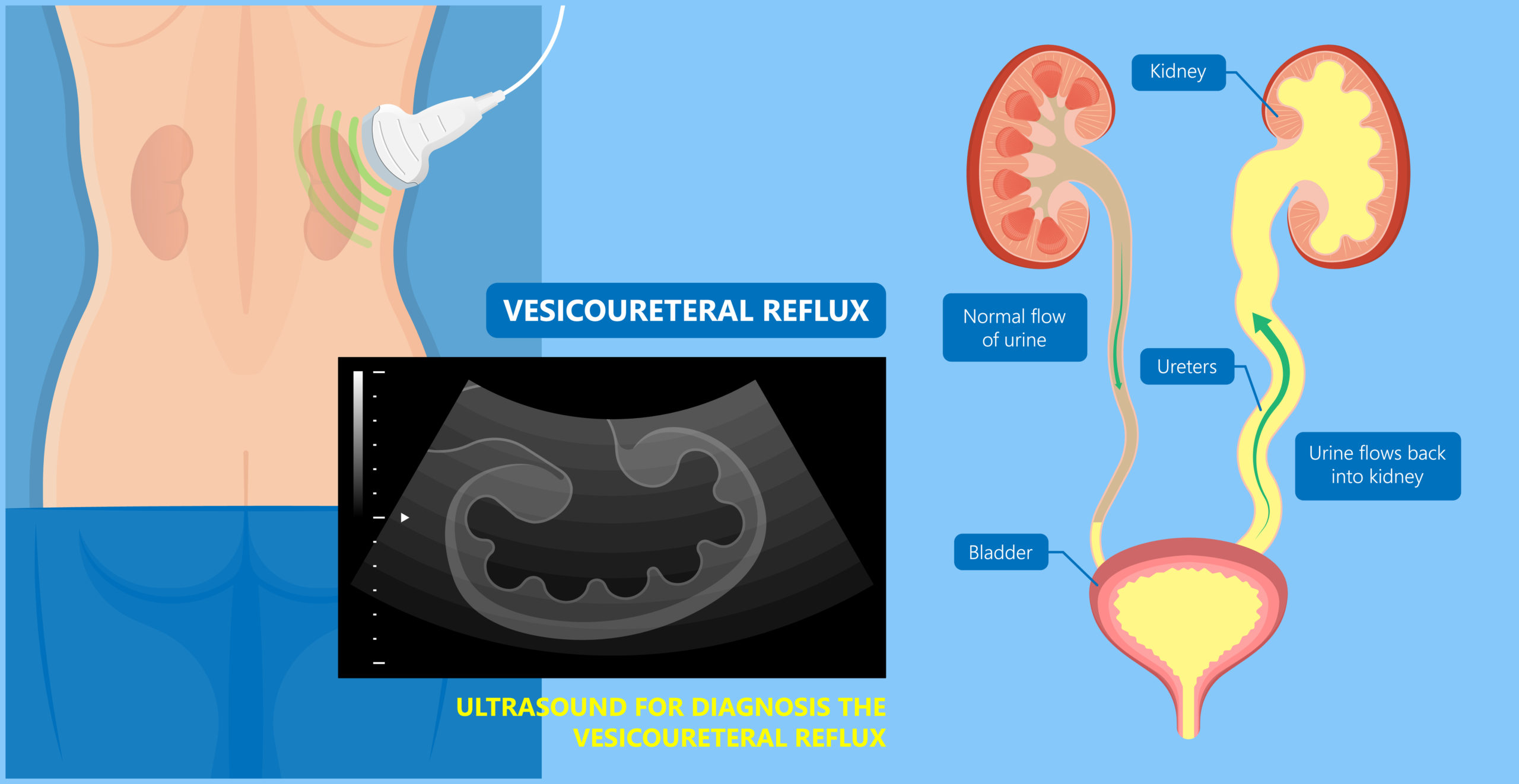 Vesicoureteral Reflux