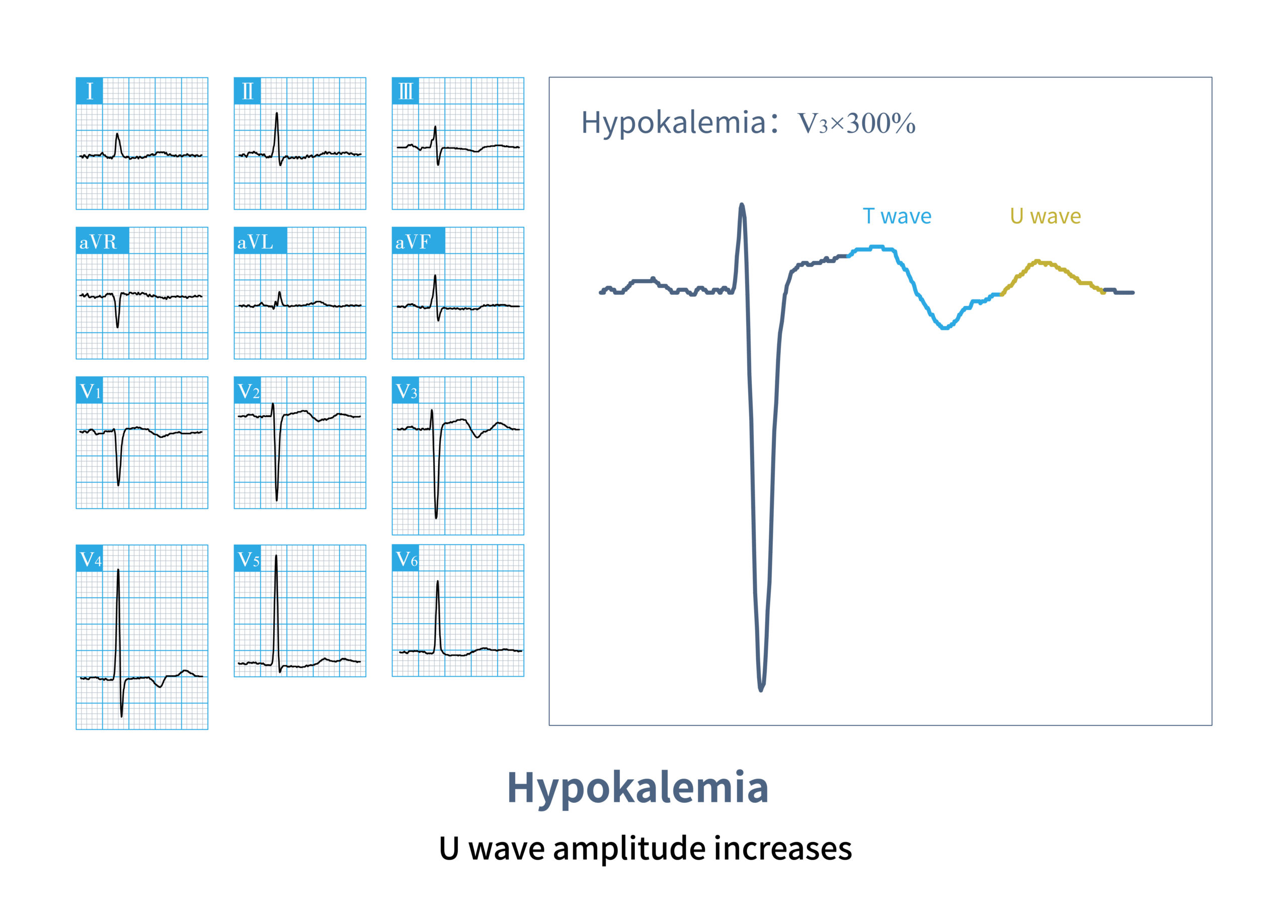 Hypokalemia
