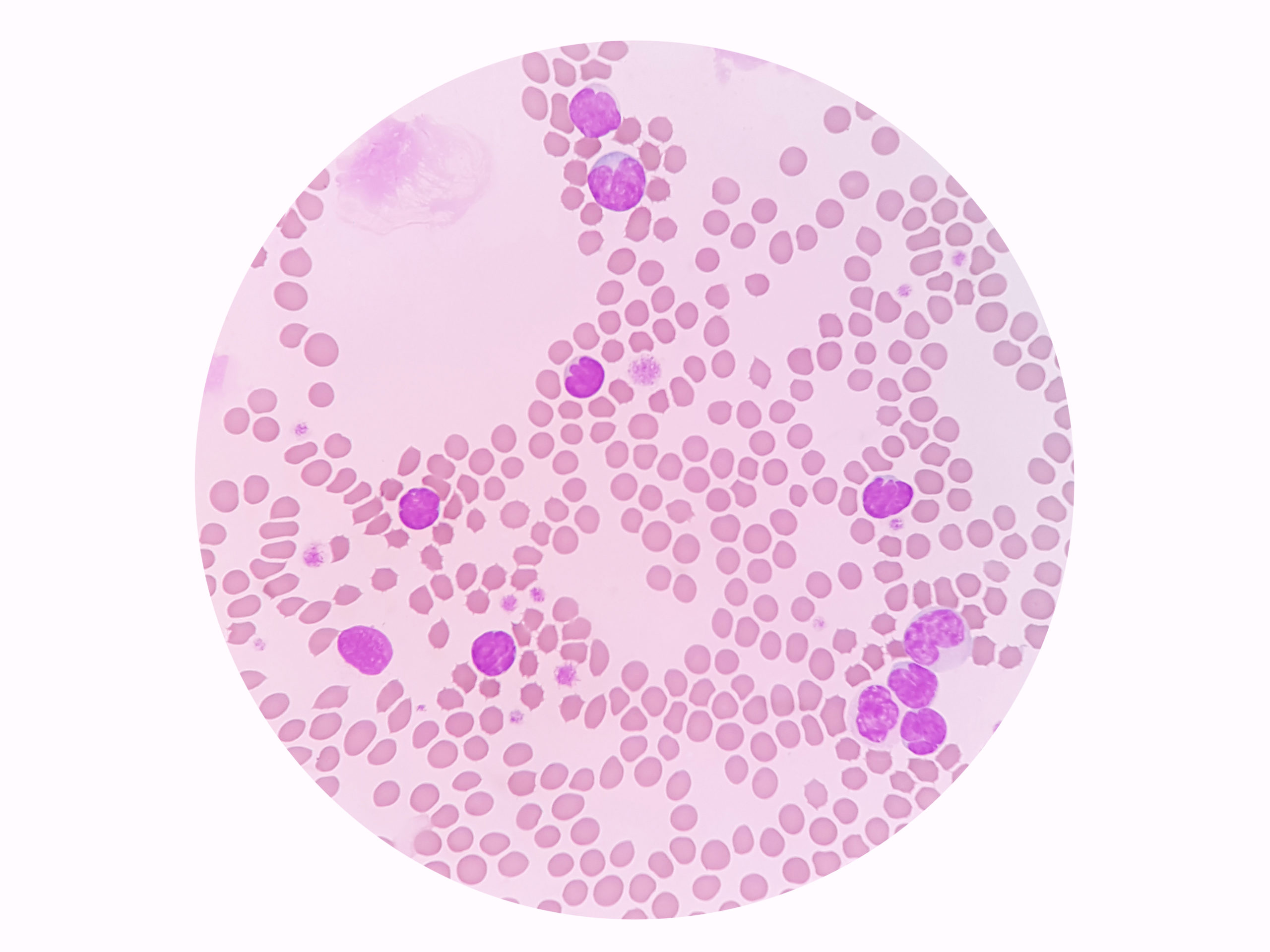 Lymphocytosis (High Lymphocyte Count)-Causes, Symptoms &amp; Treatment