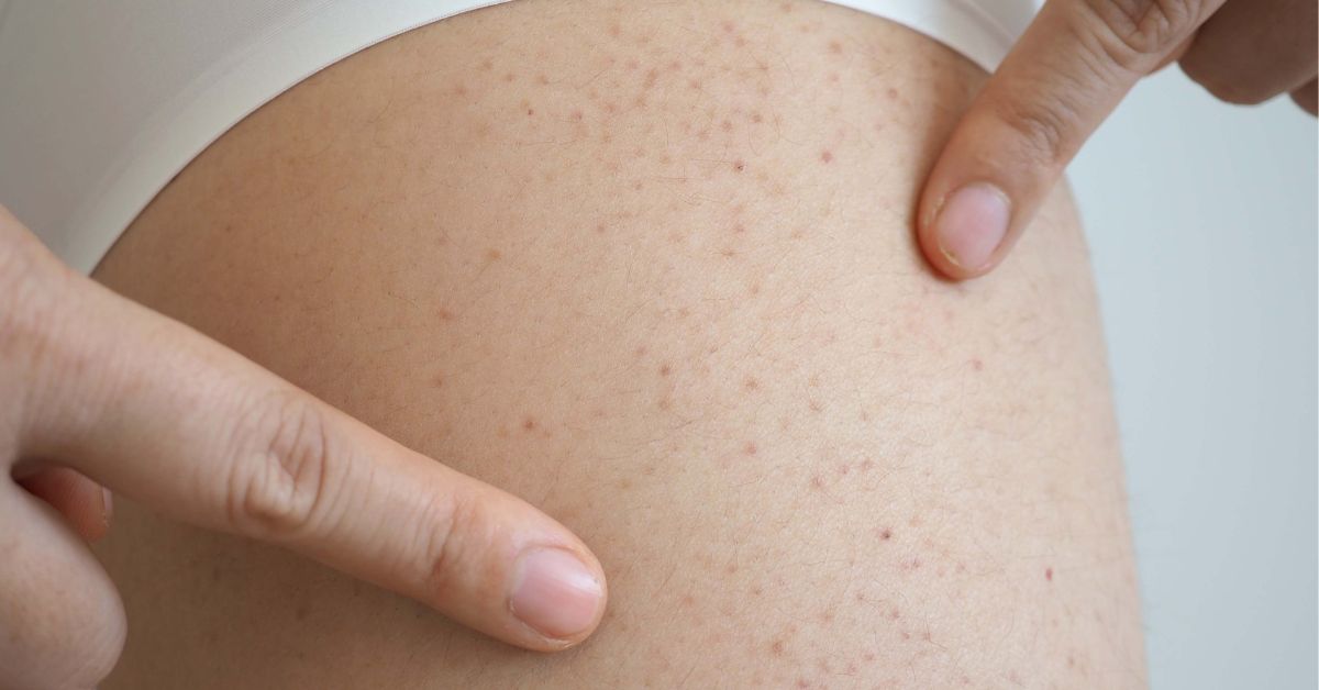 Thrombocytopenia (Low Platelet Count) : Causes, Symptoms &amp; Treatment