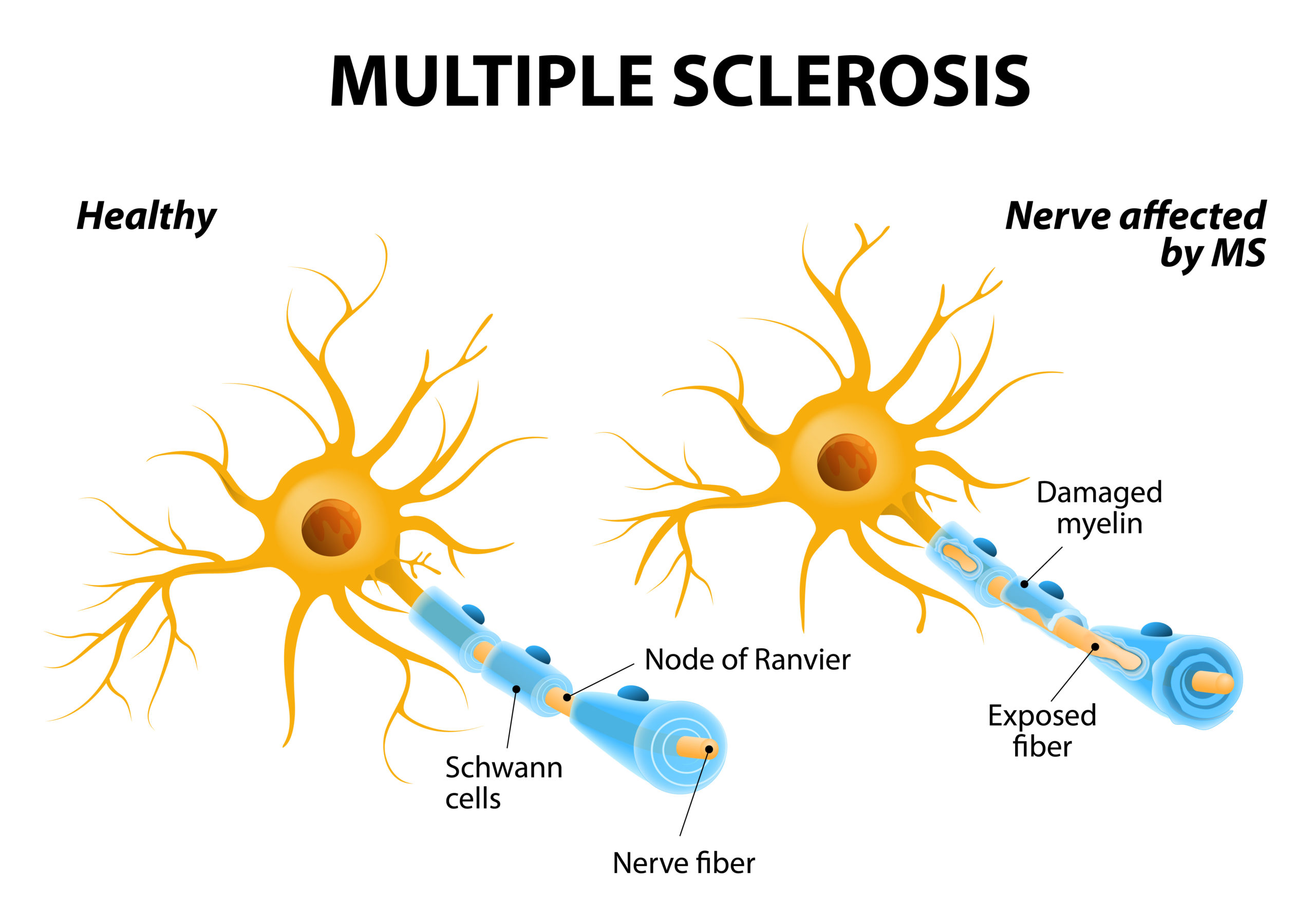 Multiple Sclerosis – Causes, Symptoms and Treatment Multiple Sclerosis – Causes, Symptoms and Treatment