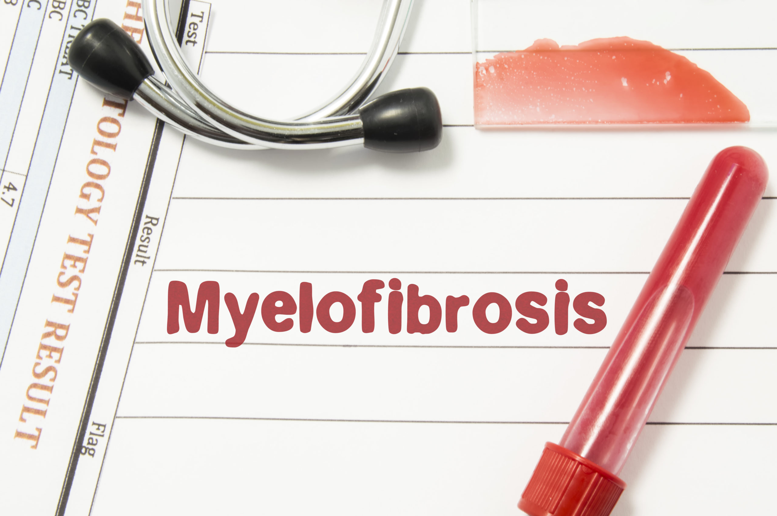 Myelofibrosis; Causes, Symptoms &amp; Treatment