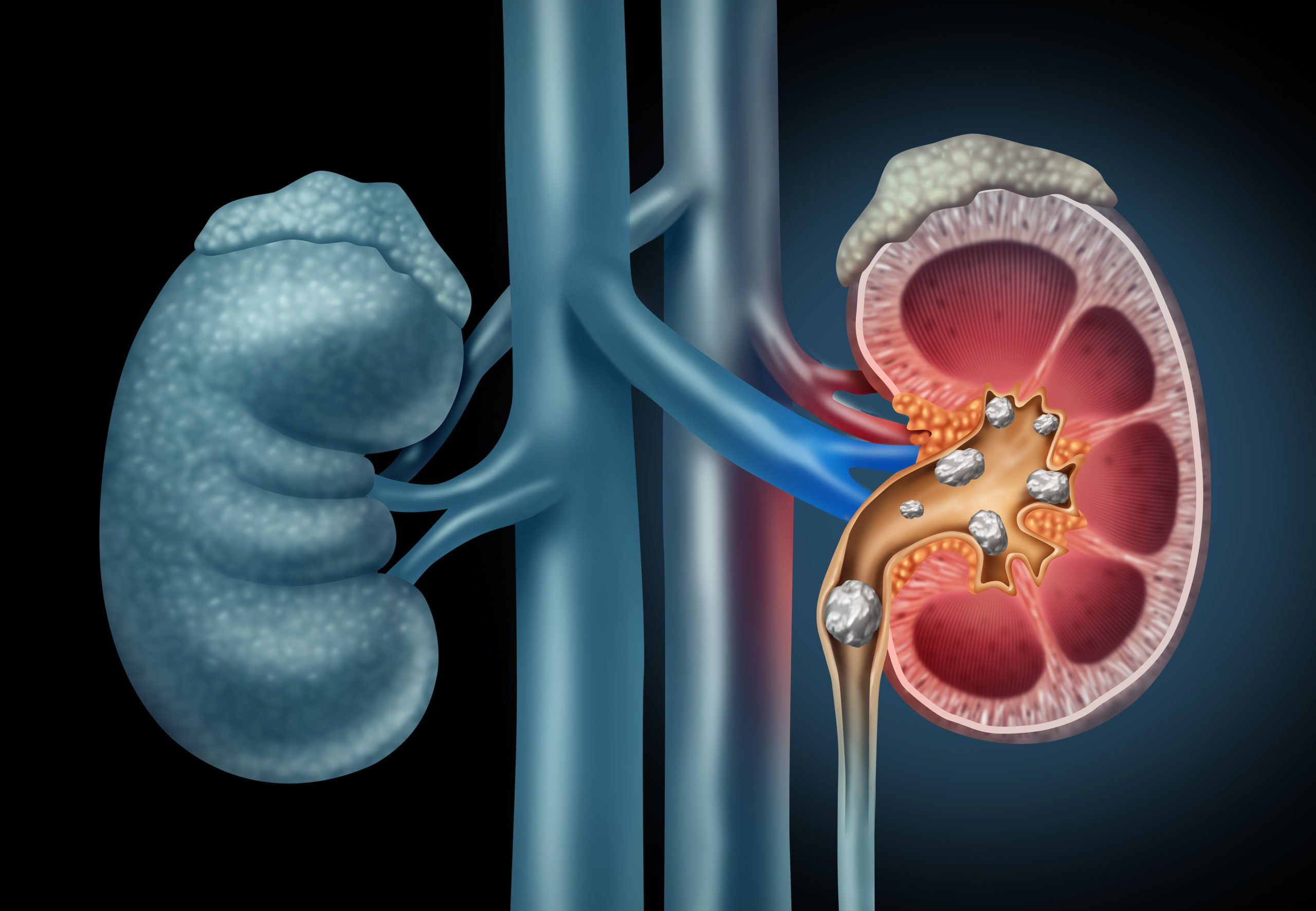 What are the various ways to remove kidney stones? What are the various ways to remove kidney stones?