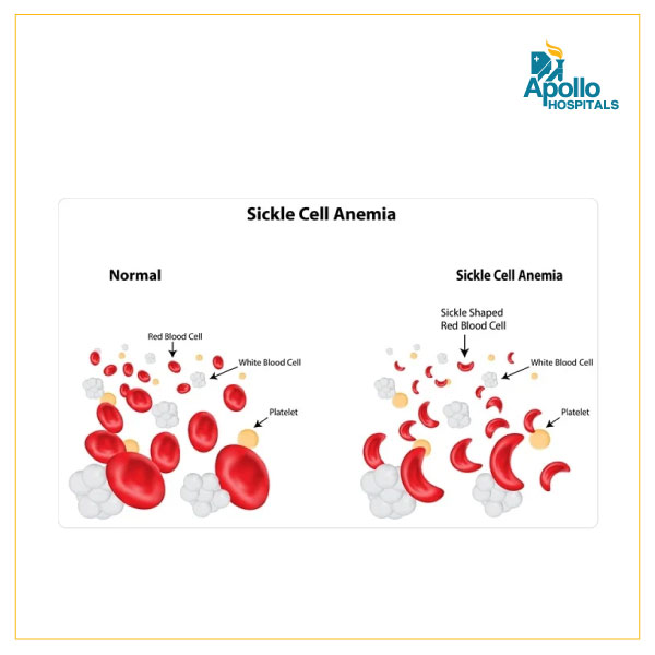 Everything you need to know about Sickle Cell Anaemia