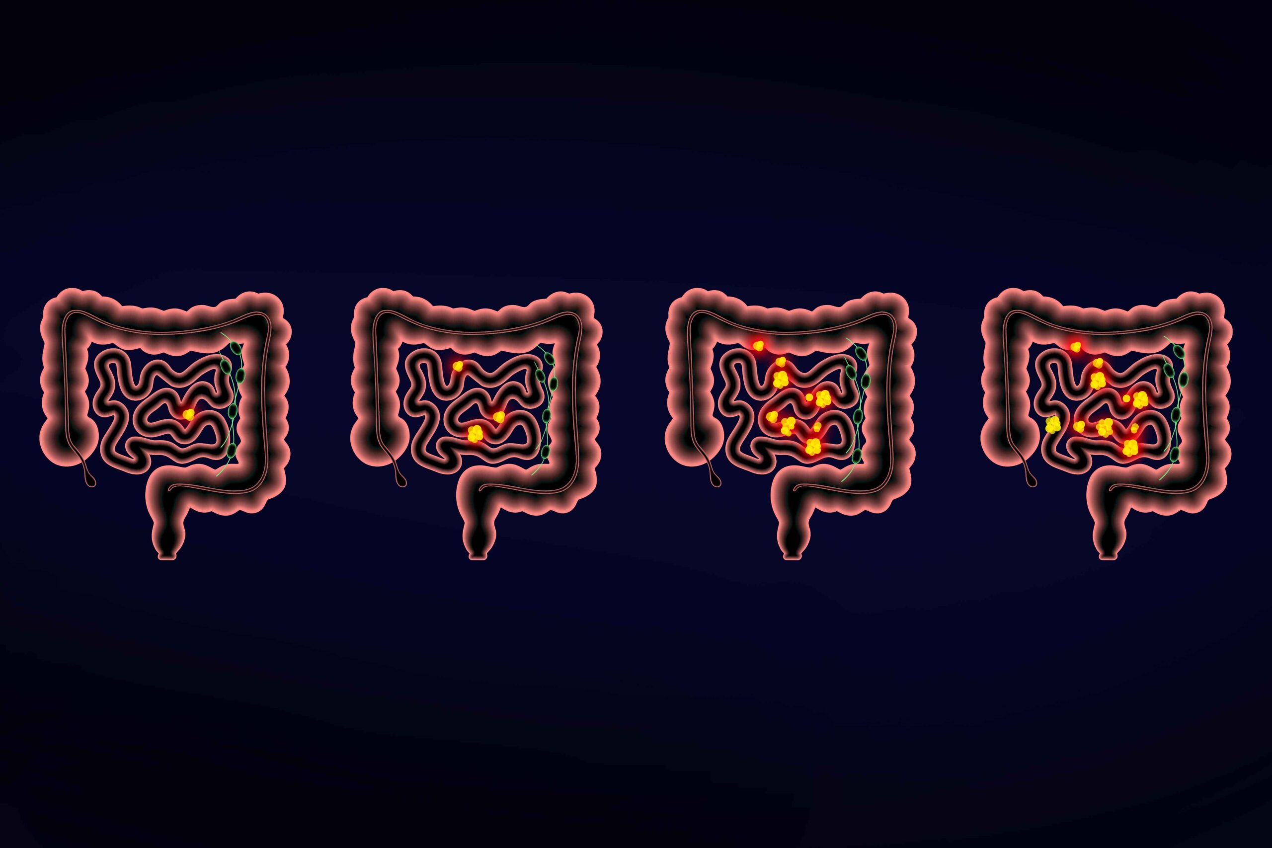 Small Intestine Cancer Stages: What to Expect