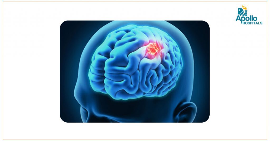 How Can A Pathologist Differentiate Between a Benign Tumour and a Malignant Tumour?