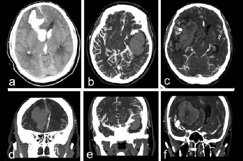 What is Aneurysmal Subarachnoid Haemorrhage?