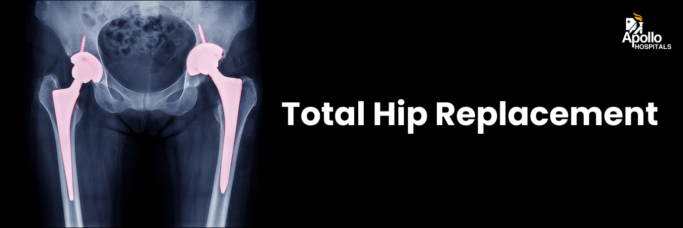 Total Hip Replacement (THR) 