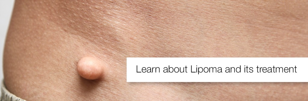 Lipoma