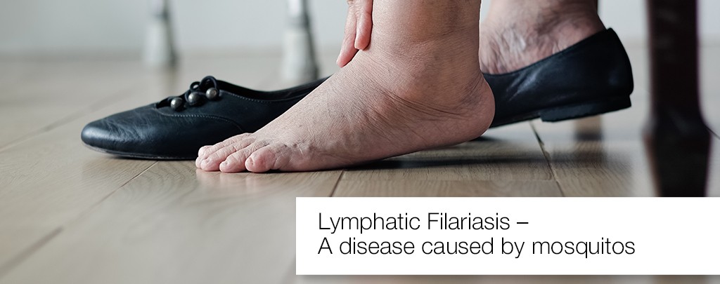Lymphatic Filariasis