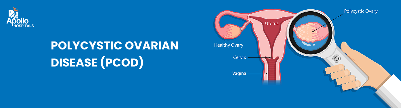 Polycystic Ovarian Disease (PCOD)