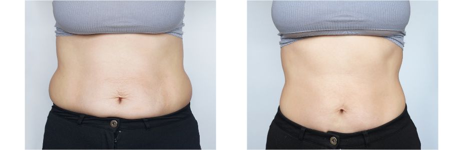 Abdominoplasty (Tummy Tuck)