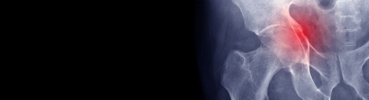 Acetabular Fractures - Causes, Symptoms, Diagnosis, Treatment, and Prevention
