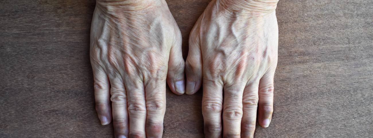 Acrocyanosis - Causes, Symptoms, Diagnosis, Treatment, and Prevention