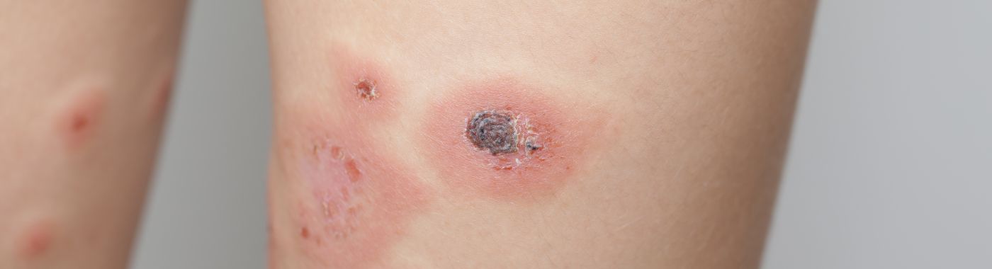 Actinomycosis - Causes, Symptoms, Diagnosis, Treatment, and Prevention