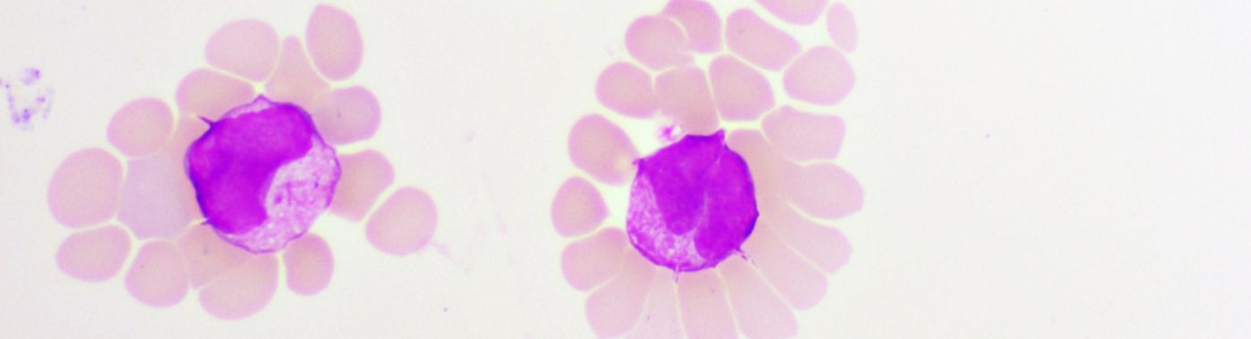 Acute Promyelocytic Leukemia - Causes, Symptoms, Diagnosis, Treatment, and Prevention