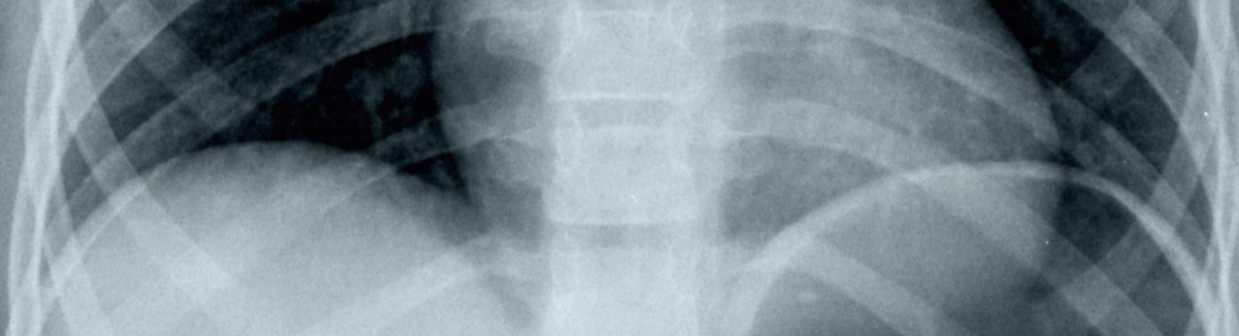 Aerophagia - Causes, Symptoms, Diagnosis, Treatment, and Prevention