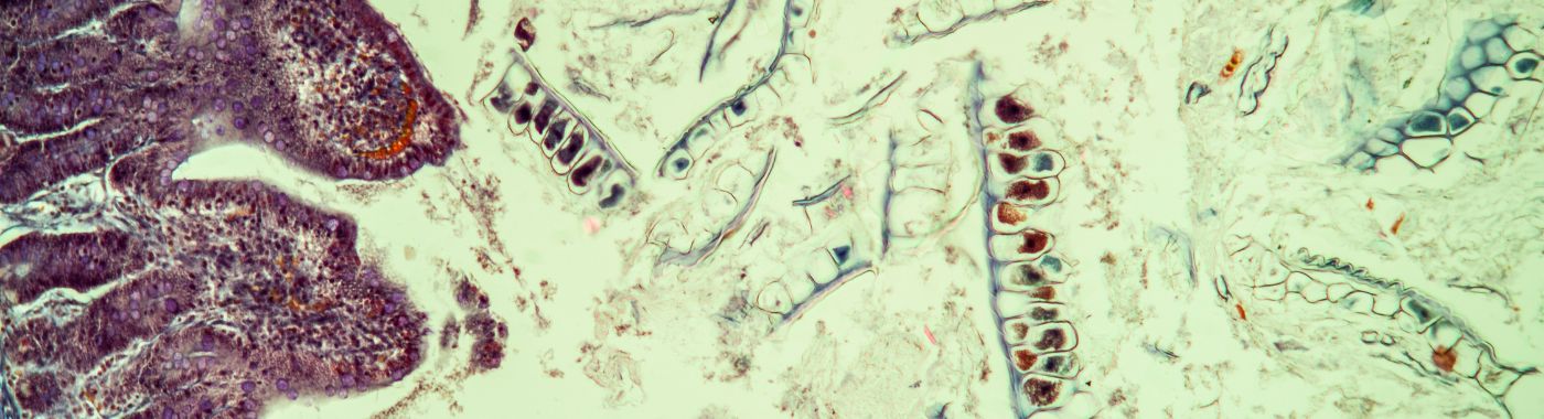 Amoebic Dysentery - Causes, Symptoms, Diagnosis, Treatment, and Prevention