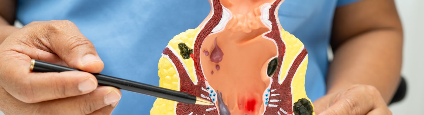 Anal Stenosis - Causes, Symptoms, Diagnosis, Treatment, and Prevention