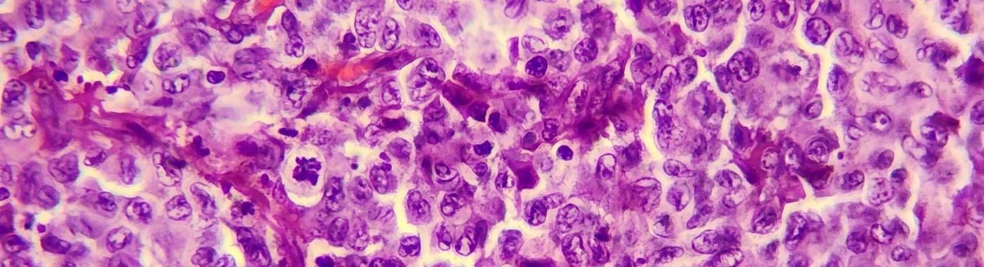 Anaplastic Large Cell Lymphoma - Causes, Symptoms, Diagnosis, Treatment, and Prevention