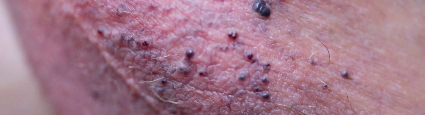 Angiokeratoma - Causes, Symptoms, Diagnosis, Treatment, and Prevention