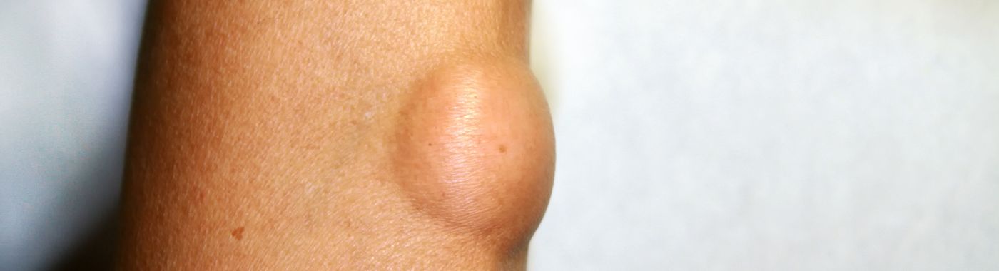 Angiolipoma - Causes, Symptoms, Diagnosis, Treatment, and Prevention