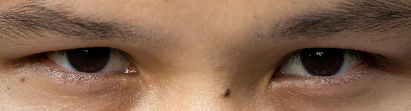 Anisocoria - Causes, Symptoms, Diagnosis, Treatment, and Prevention