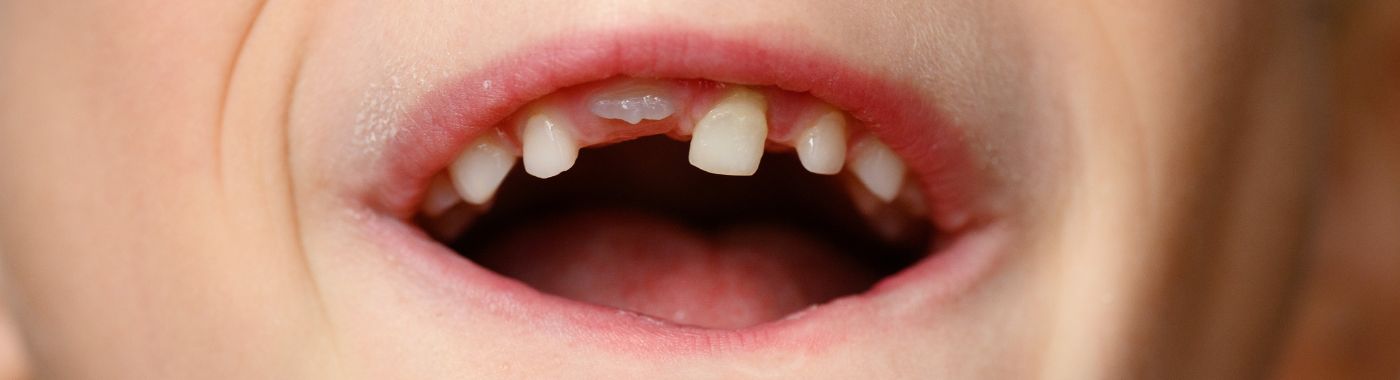 Anodontia - Causes, Symptoms, Diagnosis, Treatment, and Prevention