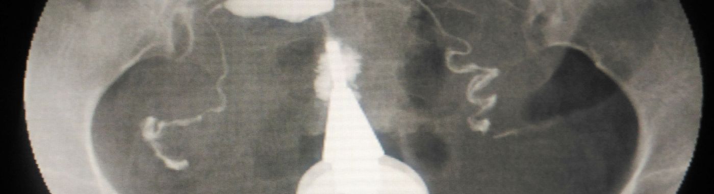 Anteverted Uterus - Causes, Symptoms, Diagnosis, Treatment, and Prevention