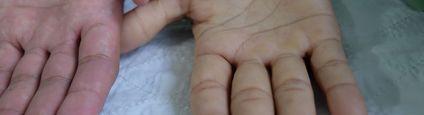 Aplasia - Causes, Symptoms, Diagnosis, Treatment, and Prevention