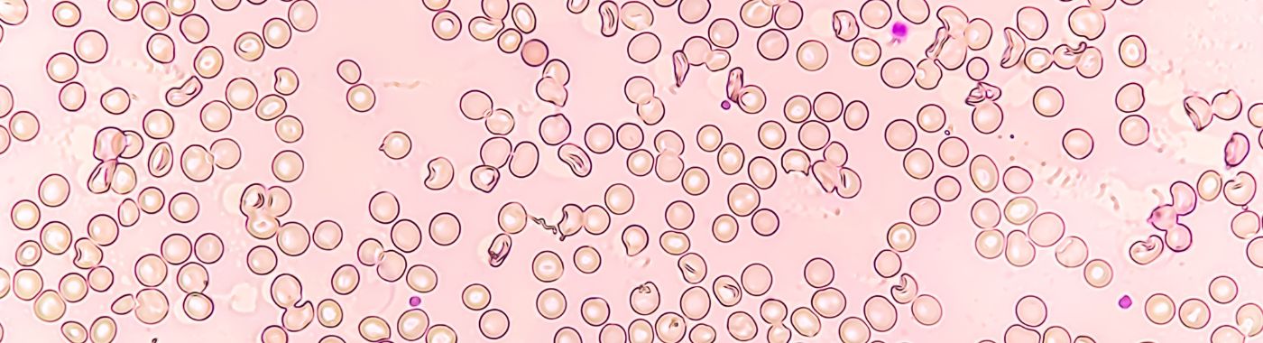 Aplastic Crisis - Causes, Symptoms, Diagnosis, Treatment, and Prevention